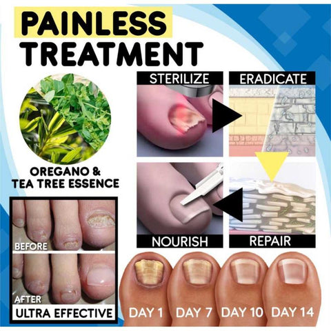 Painless Remedy For Nail Fungus Anti-fungal Nail Treatment Set