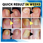 Painless Remedy For Nail Fungus Anti-fungal Nail Treatment Set